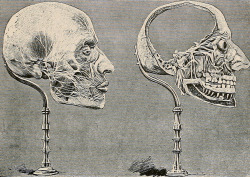 sutured-infection:  Cranial nerve anatomical preparation, Charles