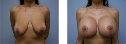 boobgrowth:  From saggy to full and round! The magic of breast