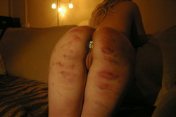 hipposloveme:My ass from last night, mm the bruises. Ass hurts