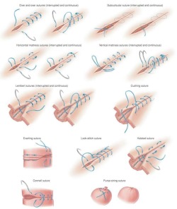 geekymedguru:  Types of surgical sutures 