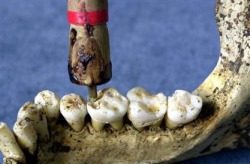 The Indus Valley Civilization has yielded evidence of dentistry