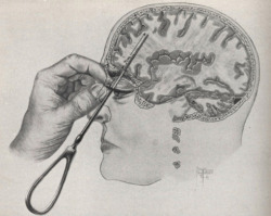 sixpenceee: This is how a lobotomy was performed in the early