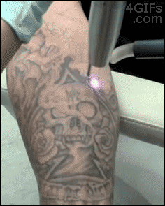 jaidefinichon:  Borrando tatuajes 