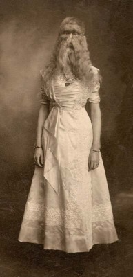 weirdvintage:  Alice E. Doherty was born in 1887 with a rare