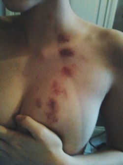 t4nb0mbshell:Hickies 