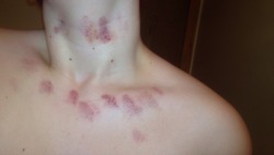 cherry-dicksicle:  i thought my hickeys looked cute