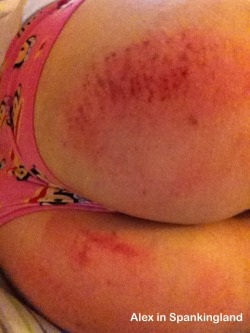 Extreme bruise closeup! An older one of me having been spanked