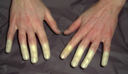 coltre:  Raynaud’s disease is a disorder of the blood vessels,