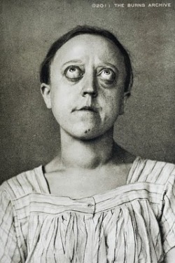 HYPERTHYROIDISM – EXOPHTHALMOS, 1908 Hyperthyroidism - the