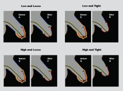 foreskin-for-skin:  Diagrams that outline various circumcision