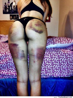 sydney-sadist:  Some very very beautiful bruises here