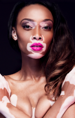 flyandfamousblackgirls: Vitiligo is a condition in which people