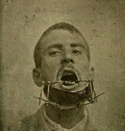 mama-macabre:  Apparatus to mend a broken jaw, 1905.
