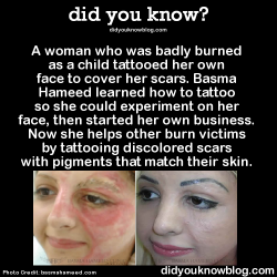 did-you-kno:  A woman who was badly burned as a child tattooed