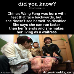 did-you-kno:  China’s Wang Fang was born with feet that face