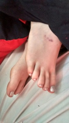 ashfeet:  Ash’s sleepy feet are very poorly and sore after