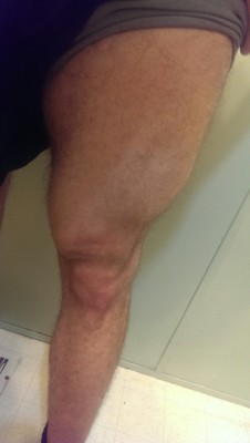 dico1610:  Leg update. Getting better still need to get more