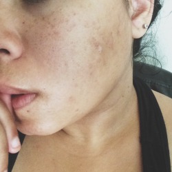 johnniewaswolf:  scars and freckers ☺️  these pictures actually