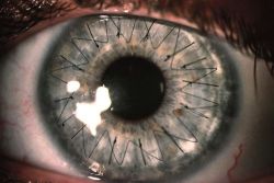 orqueen:Corneal Transplant. This is so beautiful to me.