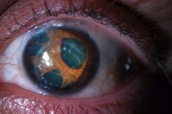  Polycoria - a medical condition of having multiple pupils in