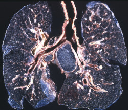 quadranopia:  Coal Worker’s Pneumoconiosis This lung disease