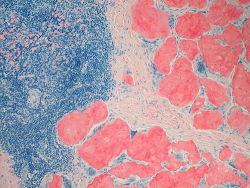 Amyloidosis Node, Congo Red