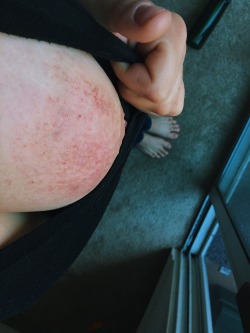 insolent-littlebrat:  This was when I tried to bruise my own