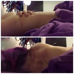 inked-m3rmaid:  My body after firecupping, sensation play  electro