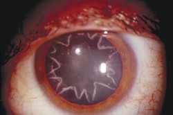 logija:  Star-Shaped Cataracts Following Electric Shock  