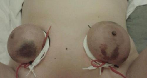 filthypainslut:  Definitely getting closer to what I want to achieve: cold, hard, purple tits ready to be punished.It hurtâ€¦a lotâ€¦and made my nipples super sensitive. I tried to get the rubber grommets to stay on but itâ€™s hard when the skinâ€™s so