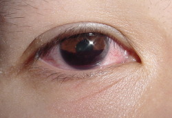 eyedefects:  Anterior hyphema, a collection of blood in the anterior