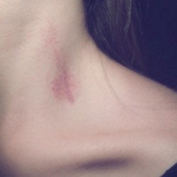 snailspeaks:  Not me and not a #hickey. I’ll tell you who it