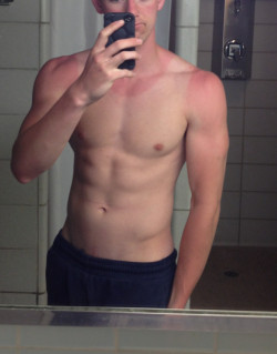 wildbait:  got a little sun burn today :/ Posted by Reddit user