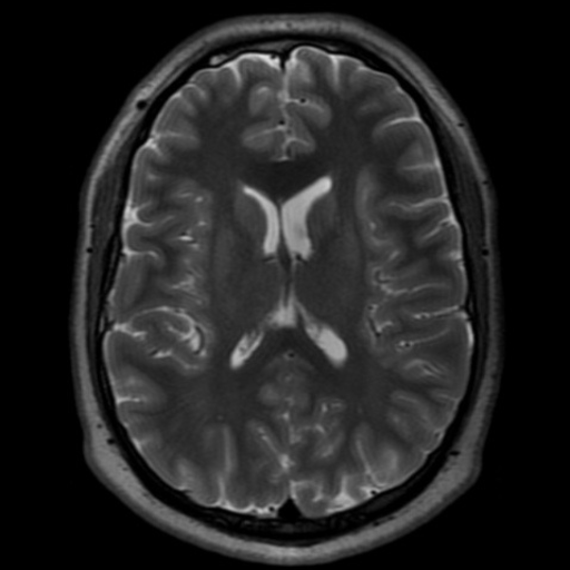 homo-medicus:  Bypass for Complex Basilar Aneurysms  This video