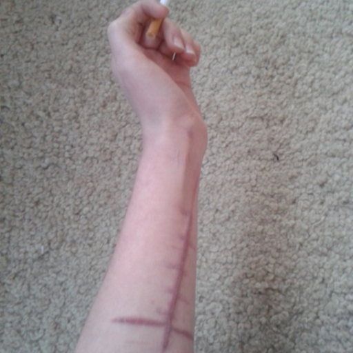 Suicide