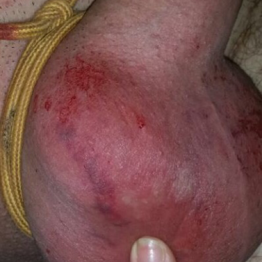 graymac41:  ballbustingtom:  my balls get hit by a sweet girl with a hammer… my balls are swollen…  Holy f..k. 