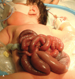 cluelessmedic:Gastroschisis  free loops of bowel in the amniotic