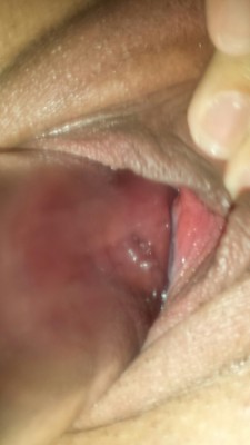 prolapsingpussy:  Penis pump sucking my wife’s cervix out to