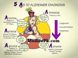 doctordconline: Alzheimer’s disease is an irreversible, progressive