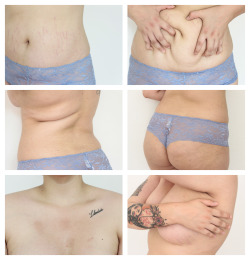  stretchmarks. self harm scars. fat. rolls. cellulite.  skin.