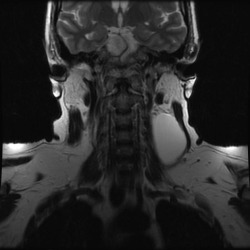 Branchial cleft cyst