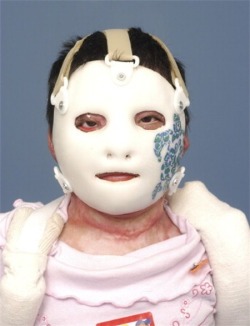 Face mask on a burn patient. Facial burns disrupt anatomical