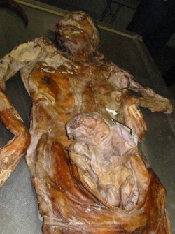 Remains of a pregnant Bosniak (Bosnian Muslim) woman and her