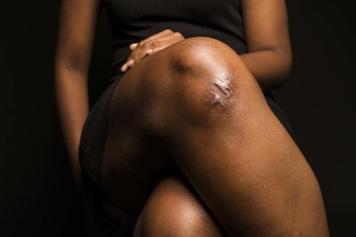 huffingtonpost:  24 Women Bare Their Scars To Reveal The Beauty In Imperfections“It’s a reminder that we can heal no matter what happens to us.”Photos by: Damon Dahlen 