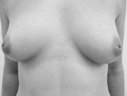 piercing-j:  londonpiercingclinic:  Inverted nipple piercing