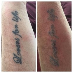 Tattoo Laser Removal done today! Get booked in for yours now!