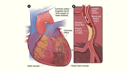 kqedscience:  New Imaging Method May Help Detect Heart Attack