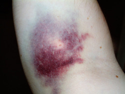 the colour of veins and bruises.