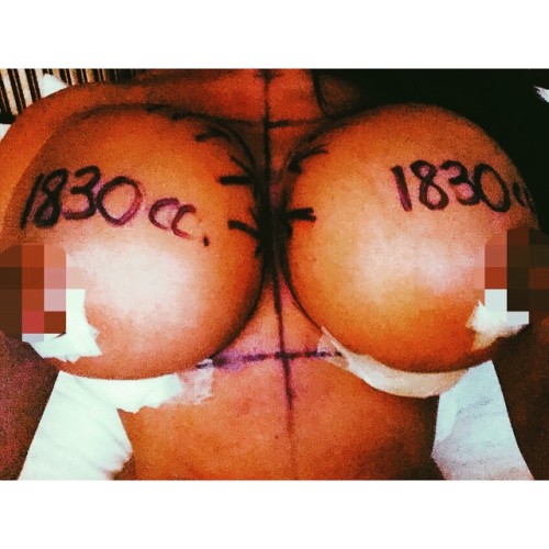 addicted2implants.tumblr.com/post/149112536993/