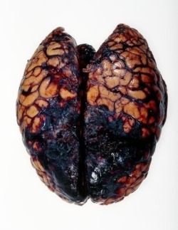 fuckyeahforensics:  Brain hemorrhage, post-mortem 